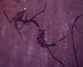 NEWS: 2-hr cable TV program to explore MORGELLONS DISEASE.