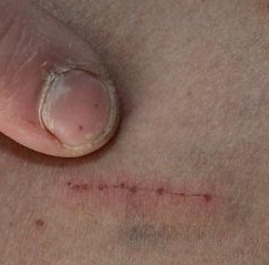 morgellons SFchron2 morgellons SFchron2
