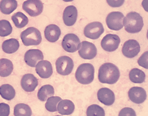 2600% increase in babesiosis infections in Wisconsin in 12 years