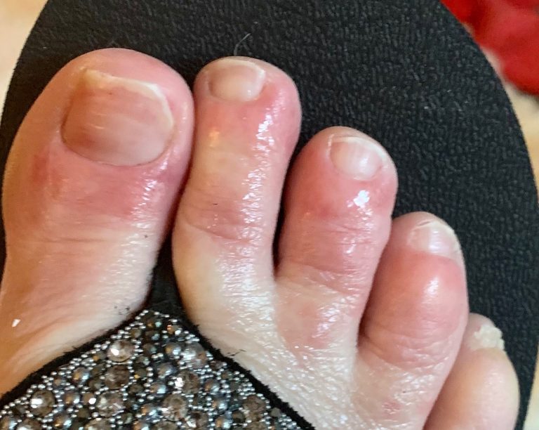 TOUCHED BY LYME Selfisolation, "COVID toes" and projectile vomiting