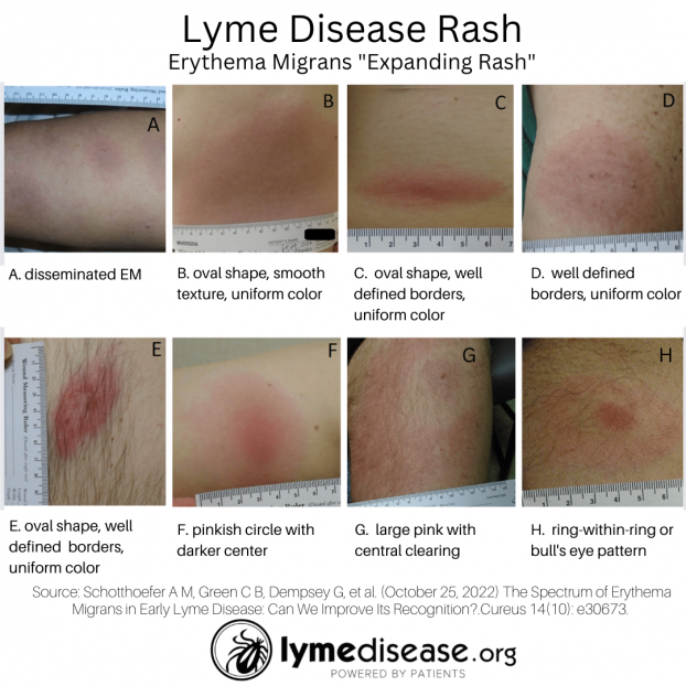 A Lyme rash doesn't always look like a bull's-eye target | LymeDisease.org