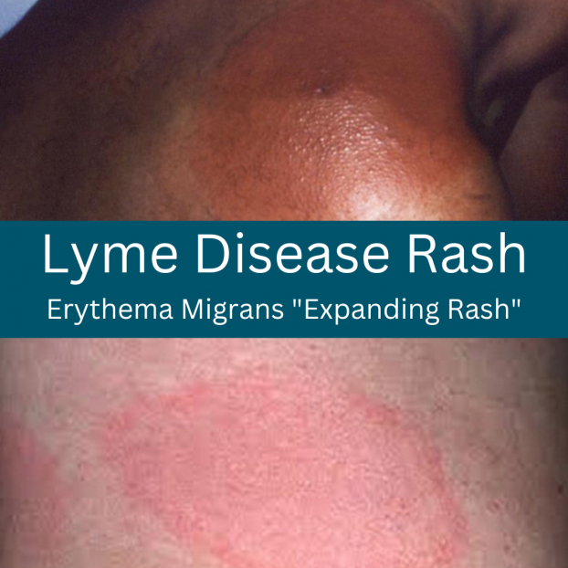 A Lyme rash doesn't always look like a bull's-eye target | LymeDisease.org